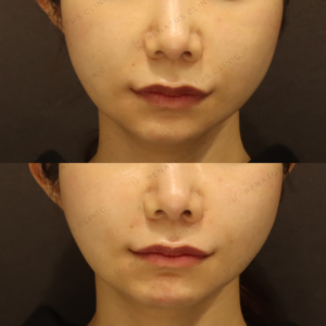 新宿のヒアルロン酸注射が上手い｜ボリフトでほうれい線・鼻翼基部を自然に整えた30代女性の記録の症例写真