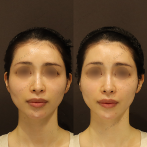 新宿のヒアルロン酸注射が上手い｜30代女性のほうれい線・鼻翼基部をボリフトで自然に改善の症例写真