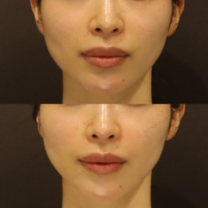 新宿のヒアルロン酸注射が上手い｜30代女性のほうれい線・鼻翼基部にボリフト使用の症例写真