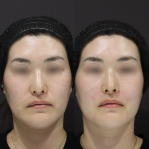 新宿でほうれい線ヒアルロン酸が上手いクリニック｜ダイヤモンドフィール使用・40代女性の効果と料金の症例写真