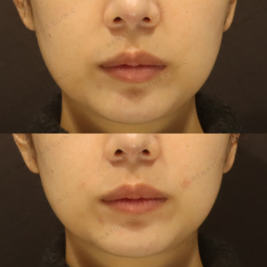 新宿でヒアルロン酸ほうれい線治療｜ボリフト使用・20代女性の効果と料金の症例写真