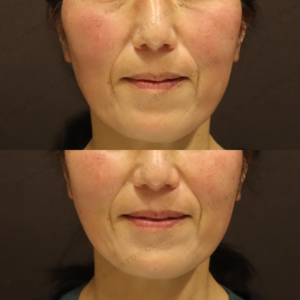 リフトアップヒアルロン酸症例写真　レナトゥスクリニックの症例写真