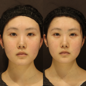 新宿で涙袋ヒアルロン酸が安いのに上手い-レナトゥスクリニックの症例写真