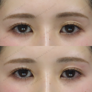 新宿の目の上ヒアルロン酸が上手い｜20代女性ボルベラ施術例の症例写真