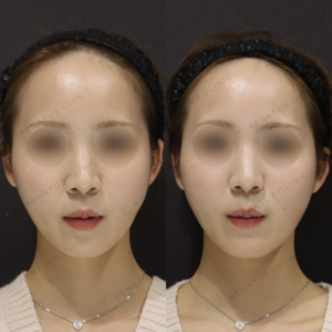 新宿で頬ヒアルロン酸が上手いクリニック｜ダイヤモンドフィール/ピネハで自然なリフトアップ（20代女性）の症例写真