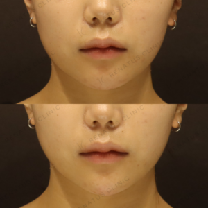 新宿で顎ヒアルロン酸がうまいクリニック｜横顔Eラインと正面スッキリを両立の症例写真