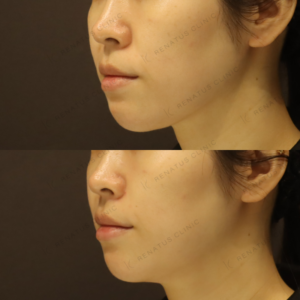新宿で鼻翼基部ヒアルロン酸｜30代女性がボリューマで小鼻を自然に整えた効果と料金の症例写真