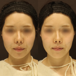 新宿で鼻翼基部ヒアルロン酸ならボリューマ｜20代女性の効果と料金相場の症例写真