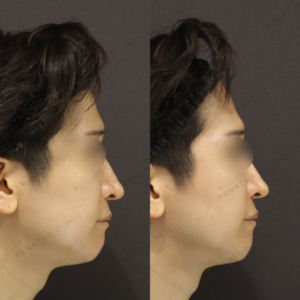 新宿で鼻翼基部ヒアルロン酸｜ボリューマで整えた40代男性の効果と費用の症例写真