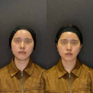 顎ヒアルロン酸症例写真 レナトゥスクリニック　名古屋で上手い安いヒアルロン酸治療の症例写真