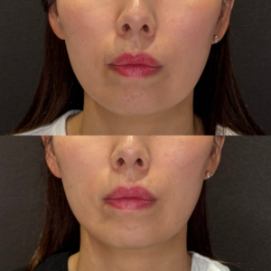 名古屋で口角ヒアルロン酸が上手いクリニック｜40代女性がダイヤモンドフィール/ピネハで自然な口元への症例写真