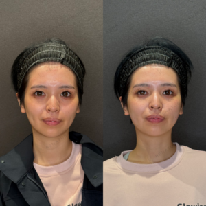 【頬コケ改善】頬ヒアルロン酸症例写真　レナトゥスクリニック名古屋院の症例写真