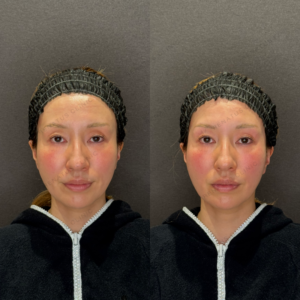 目の上ヒアルロン酸症例写真｜レナトゥスクリニック　名古屋フィラーの名医の症例写真