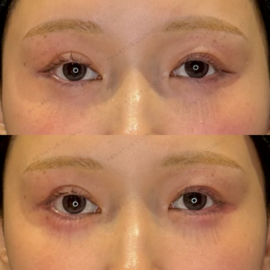 涙袋ヒアルロン酸症例写真｜レナトゥスクリニック名古屋院　名駅直通のヒアル治療の症例写真