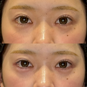 名古屋で涙袋ヒアルロン酸｜10代女性がボルベラで自然な涙袋を作った効果と費用の症例写真