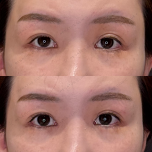 名古屋で目の上ヒアルロン酸｜30代女性がボルベラで若返り効果・料金相場を解説の症例写真