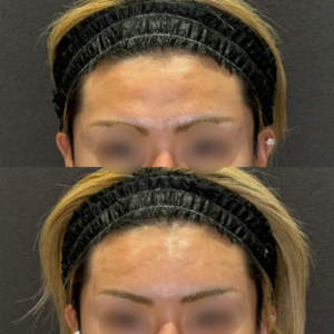 名古屋で額ヒアルロン酸ボルベラ｜20代男性の費用・効果・仕上がりの症例写真