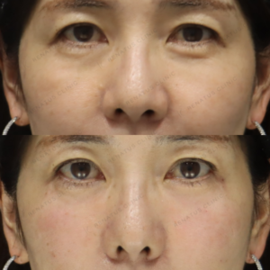 新宿のベビーコラーゲンで上手いクマ治療｜50代女性の自然な仕上がりの症例写真