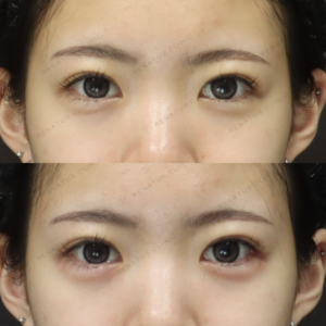 新宿の涙袋ヒアルロン酸が上手いクリニック｜ボルベラで自然に仕上げた20代女性の記録の症例写真