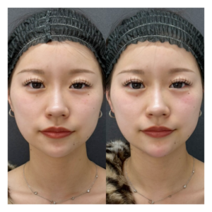 新宿の涙袋・顎ヒアルロン酸で小顔Eライン｜ボラックスで自然な立体感を実現の症例写真