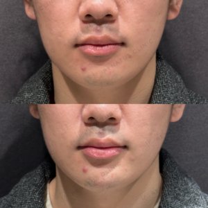 東京田町のヒアルロン酸顎形成が上手い｜20代男性・ボラックス使用の症例写真