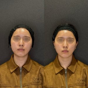 顎ヒアルロン酸症例写真 レナトゥスクリニック　名古屋で上手い安いヒアルロン酸治療の症例写真
