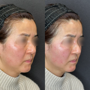 大阪梅田でゴルゴライン・頬のヒアルロン酸｜50代女性がボリューマで若返り効果を実感の症例写真