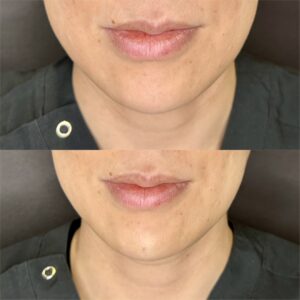 大阪顎ヒアルロン酸メンズ症例の症例写真