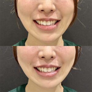 大阪で人気のほうれい線ヒアルロン酸の症例写真
