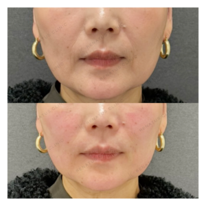 ほうれい線ヒアルロン酸ボリフト症例写真の症例写真