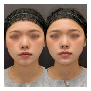 福岡天神でヒアルロン酸（顎）ボラックス注入｜20代女性の効果と料金相場の症例写真