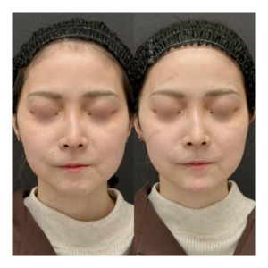 福岡天神でヒアルロン酸顎形成｜ボラックスで理想のEラインを叶えた30代女性の効果と料金の症例写真