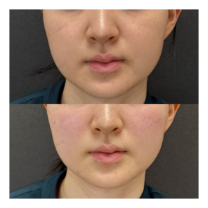 福岡天神のゴルゴラインヒアルロン酸｜20代女性がボリューマで実感した効果と料金相場の症例写真