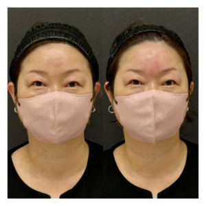 額ヒアルロン酸ボリューマ症例写真の症例写真