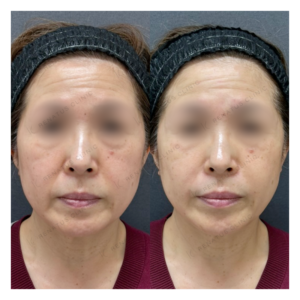 ほうれい線ヒアルロン酸症例写真の症例写真