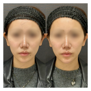 顎ヒアルロン酸症例写真の症例写真