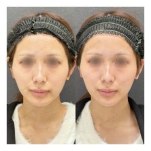 福岡天神のヒアルロン酸注射（顎）が上手い｜ボラックス使用・20代女性の症例写真