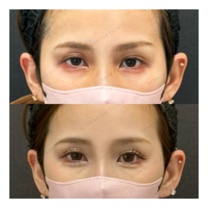 福岡天神で目の下のクマ取り｜30代女性の効果・料金相場の症例写真