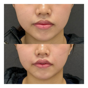 福岡天神のヒアルロン酸で鼻翼基部・唇を自然に整えた20代女性｜ボリューマ・ボルベラの効果と料金の症例写真