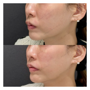 鼻翼基部・ほうれい線・顎ヒアルロン酸ボリューマ・ボリフト・ボラックス症例写真の症例写真