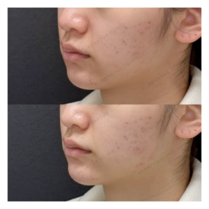 福岡で顎ヒアルロン酸（ボラックス）をプロに頼みたい方へ｜Eラインを自然に整えるの症例写真