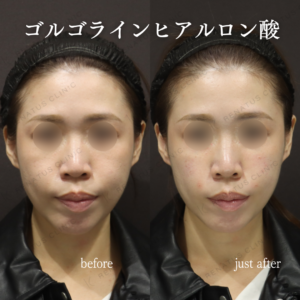 新宿でゴルゴライン・ほうれい線ヒアルロン酸｜30代女性がボリューマで若返り効果を実感の症例写真