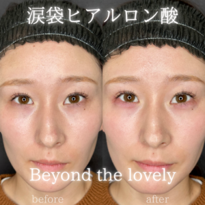 大阪梅田の涙袋ヒアルロン酸｜ボルベラで自然な涙袋を作った20代女性の効果と料金の症例写真