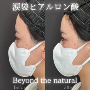 大阪梅田の涙袋ヒアルロン酸｜ボルベラで20代女性が感じた効果と料金相場の症例写真