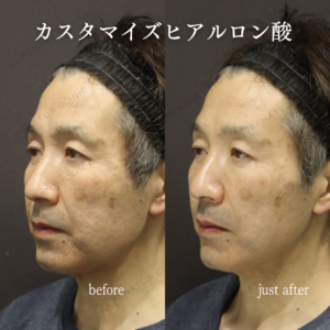 新宿ヒアルロン酸リフトアップの効果と料金｜ボリューマで50代男性のたるみ改善の症例写真