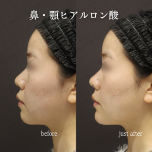 新宿で鼻・顎ヒアルロン酸が上手いクリニック｜ボラックスで20代女性の小顔・鼻筋を自然に形成の症例写真