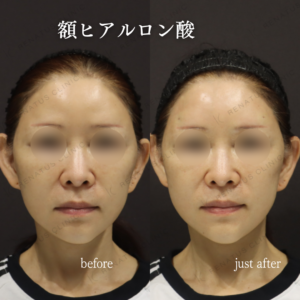 新宿で額ヒアルロン酸（ボリフト）60代女性の効果と料金相場の症例写真