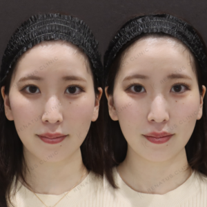 新宿で涙袋ヒアルロン酸｜ボリフト使用・20代女性におすすめの効果と料金相場の症例写真