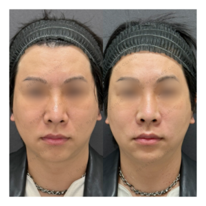 福岡天神のヒアルロン酸でほうれい線・鼻翼基部を改善｜ボリフト・ボリューマ40代男性の効果と料金相場の症例写真