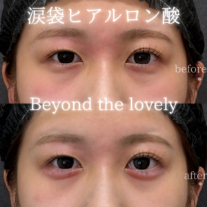 福岡天神の涙袋ヒアルロン酸｜10代女性がボルベラで自然な涙袋を形成した効果と料金の症例写真